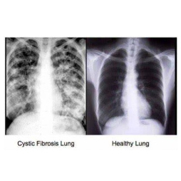 CF vs Healthy Lungs